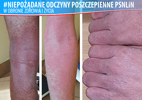Nasilenie atopowego zapalenia skóry po "szczepieniu" przeciw Covid-19
